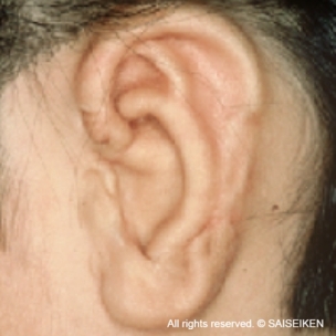 耳介軟骨が再生して耳の形ができる