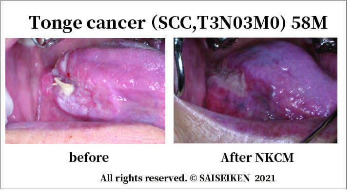 Tonge cancer （SCC,T3N03M0) 58Ｍ