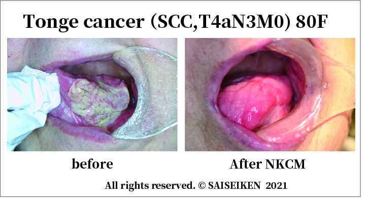 Tonge cancer （SCC,T4aN3M0) 80F