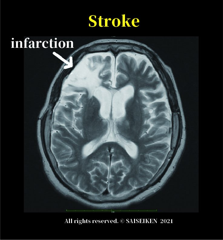 脳梗塞