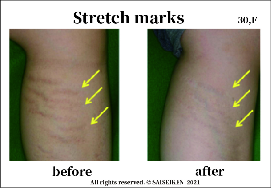 Stretch marks