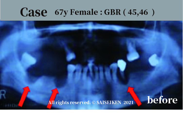 Case　67y Female : GBR ( 45,46  )